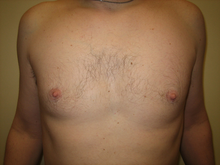 10a. Gynecomastia After