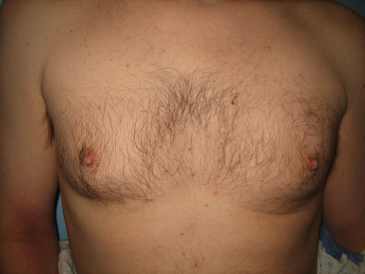 10a. Gynecomastia Before