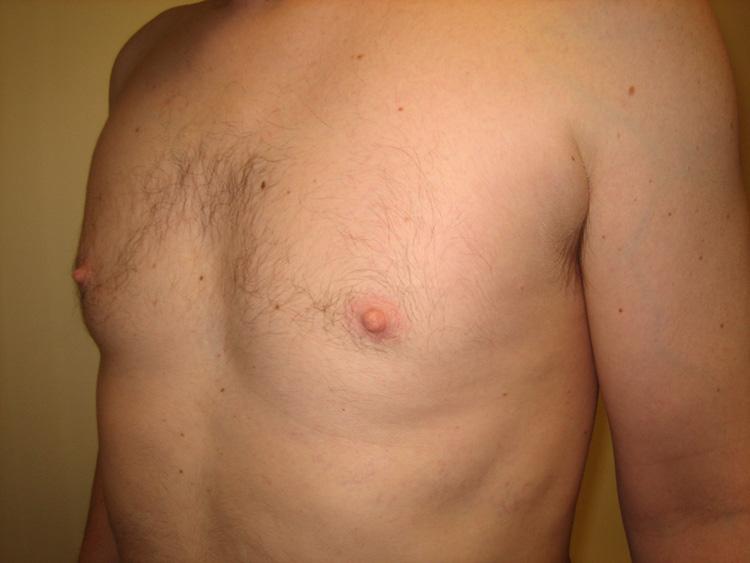 10b. Gynecomastia After