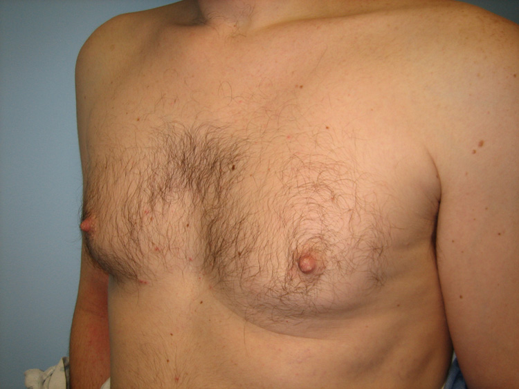 10b. Gynecomastia Before