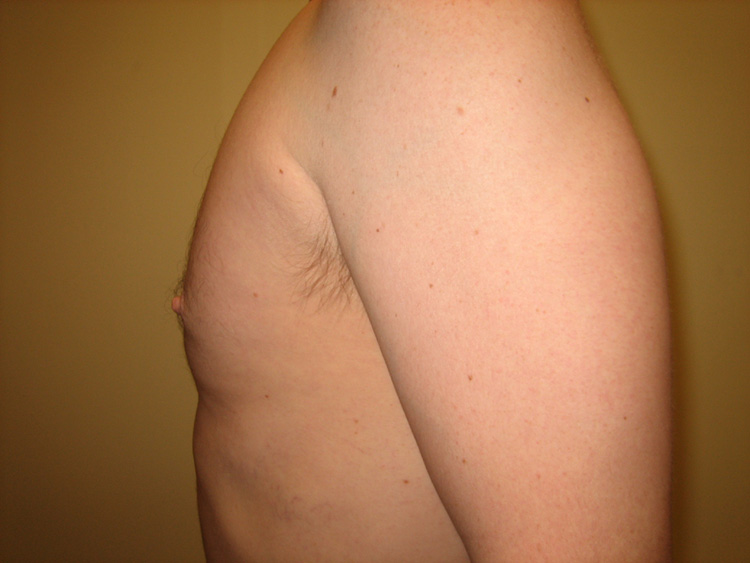 10c. Gynecomastia After