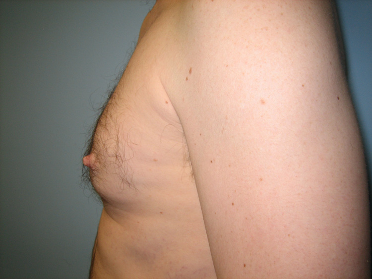 10c. Gynecomastia Before