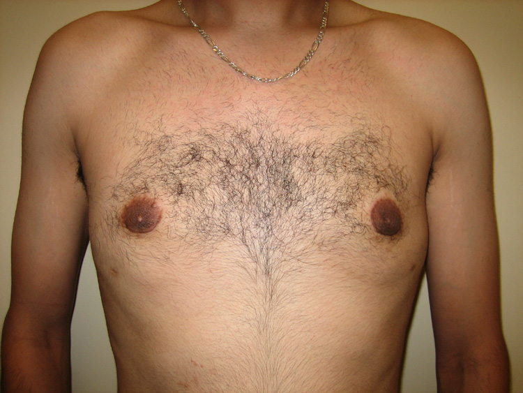 11a. Gynecomastia After