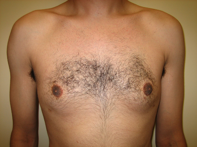 11a. Gynecomastia Before