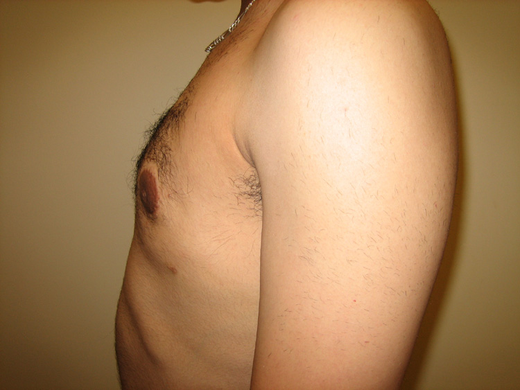 11b. Gynecomastia After