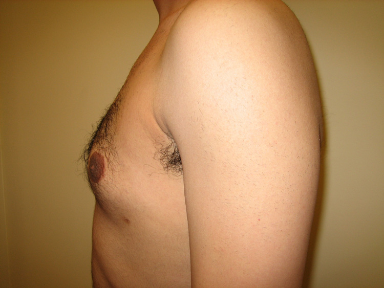 11b. Gynecomastia Before