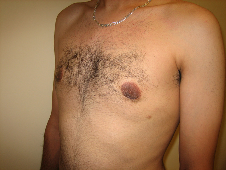 11c. Gynecomastia After