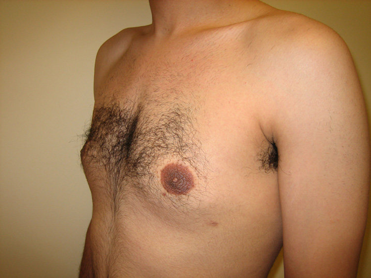 11c. Gynecomastia Before