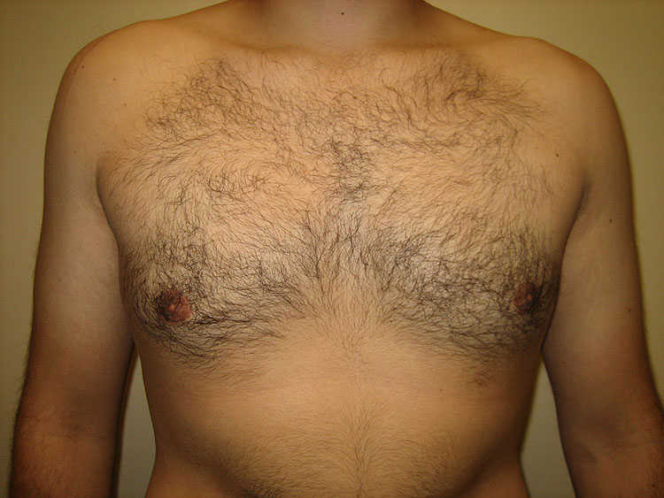 13a. Gynecomastia After