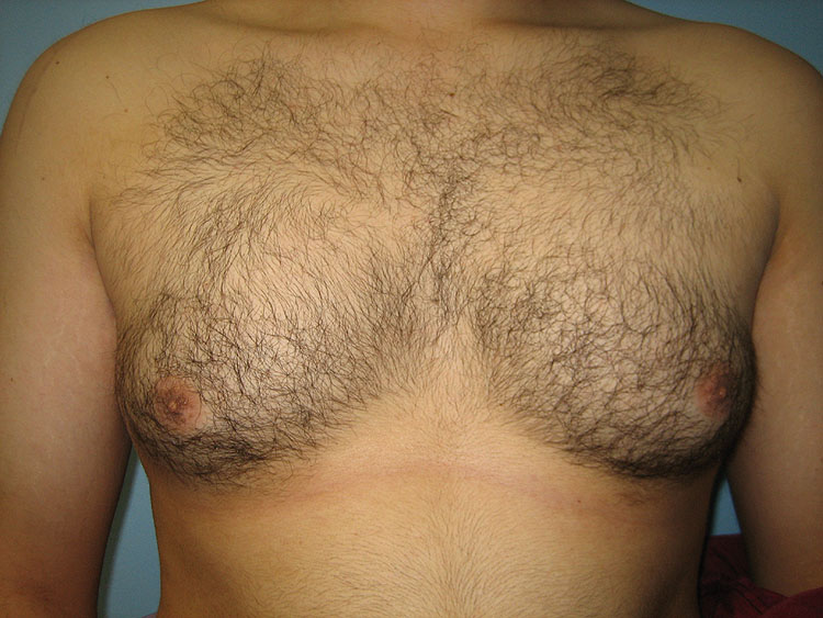 13a. Gynecomastia Before