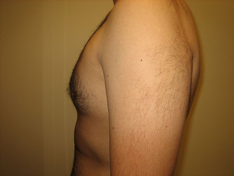 13b. Gynecomastia After