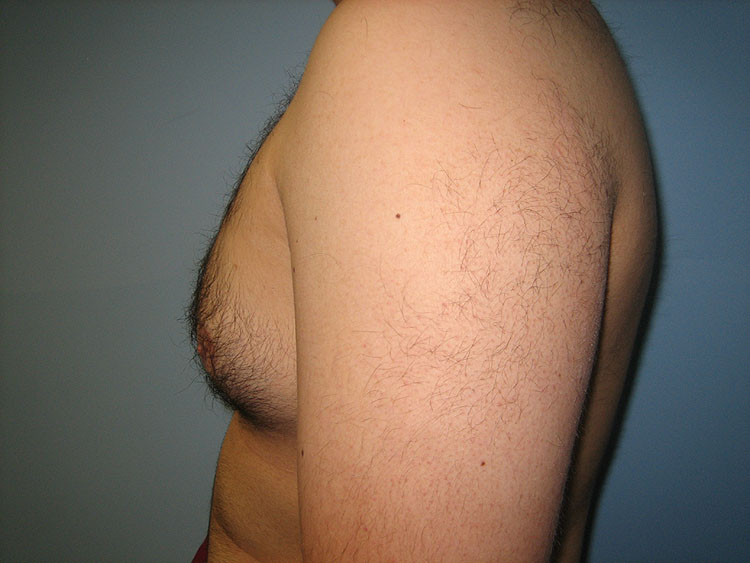 13b. Gynecomastia Before