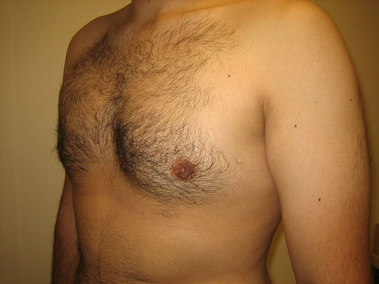 13c. Gynecomastia After