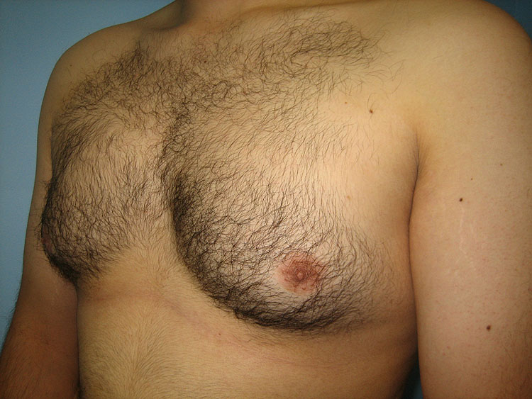 13c. Gynecomastia Before