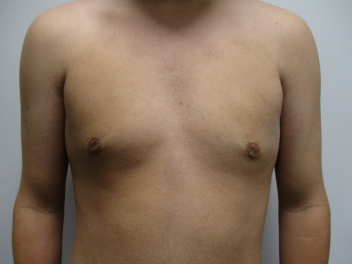 15a. Gynecomastia After