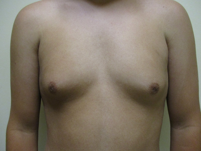 15a. Gynecomastia Before