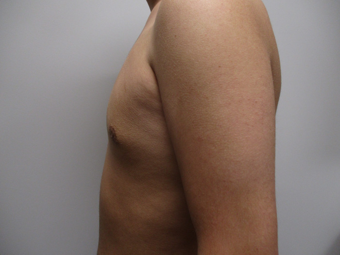 15b. Gynecomastia After