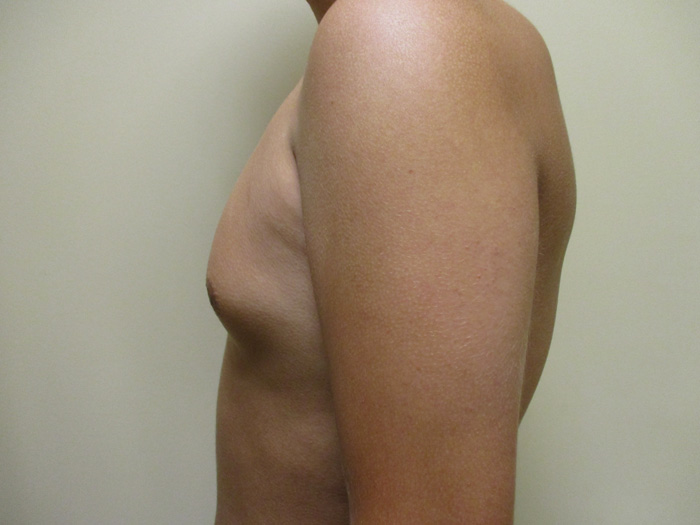 15b. Gynecomastia Before