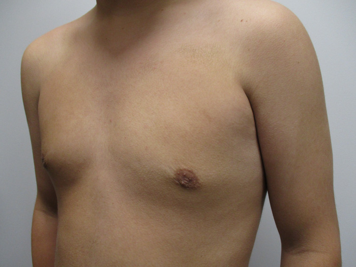 15c. Gynecomastia After