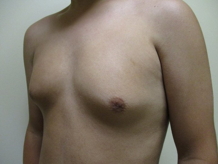 15c. Gynecomastia Before