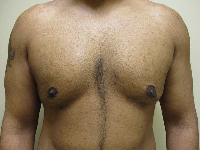 3a. Gyno After