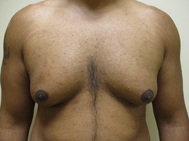 3a. Gyno Before