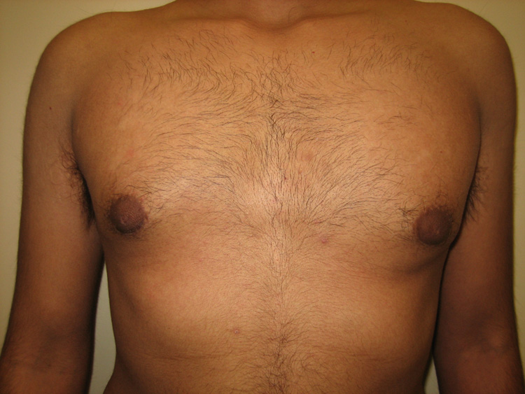 4a. Gyno After