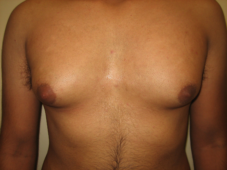 4a. Gyno Before