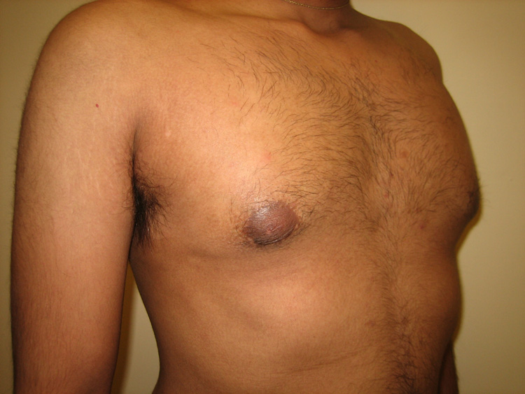 4c. Gyno After