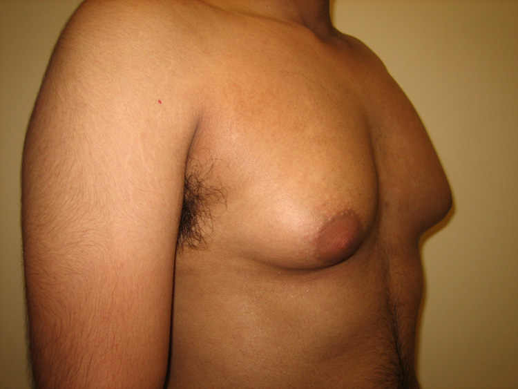 4c. Gyno Before