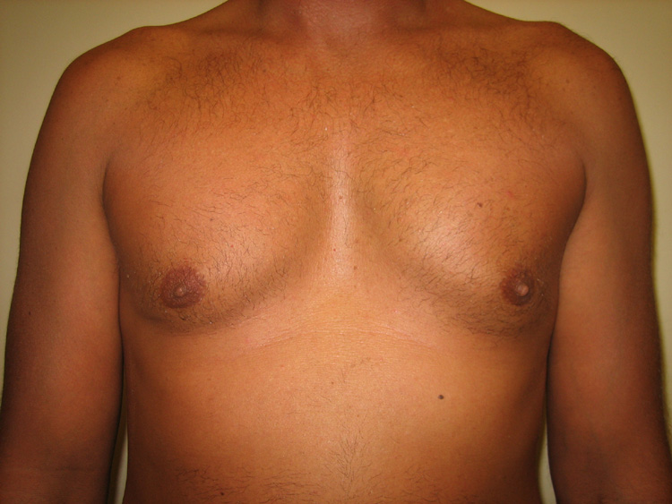 5a. Gyno After