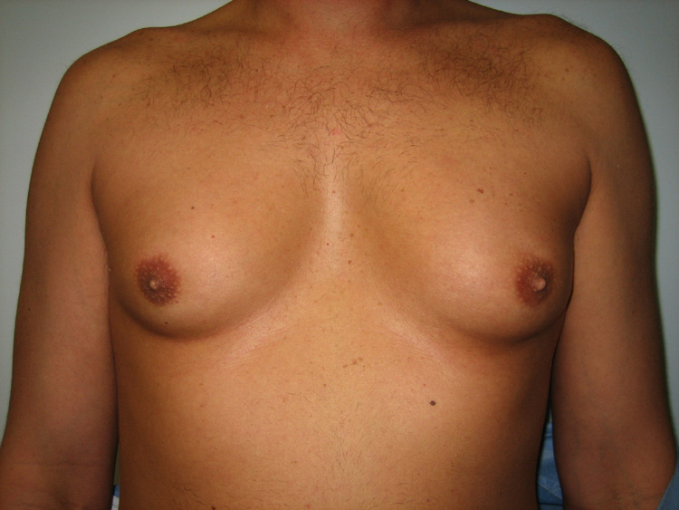 5a. Gyno Before