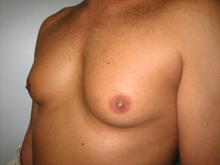 5c. Gyno Before