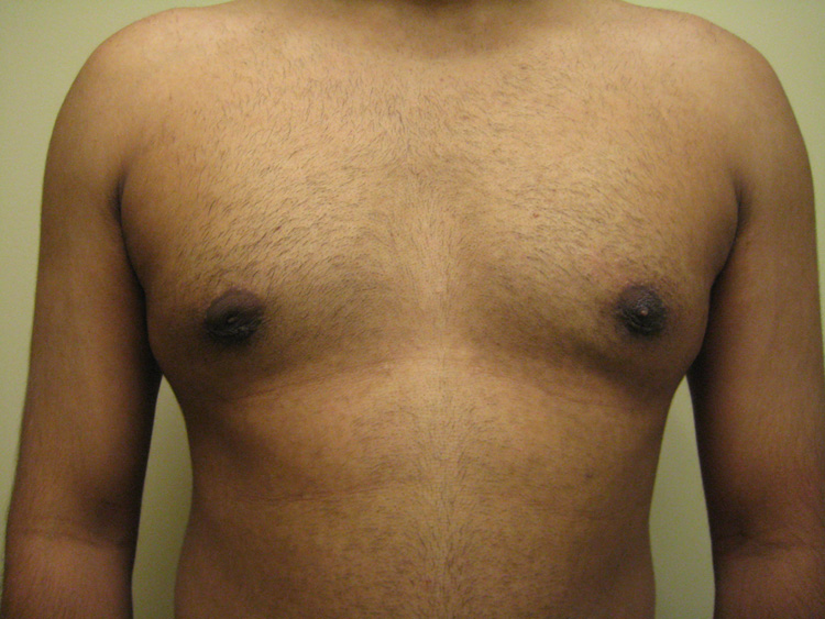 6a. Gyno After