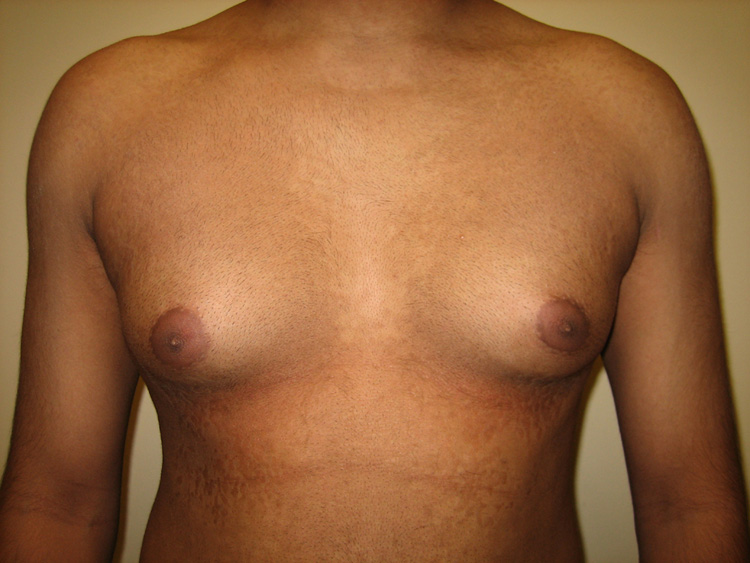 6a. Gyno Before