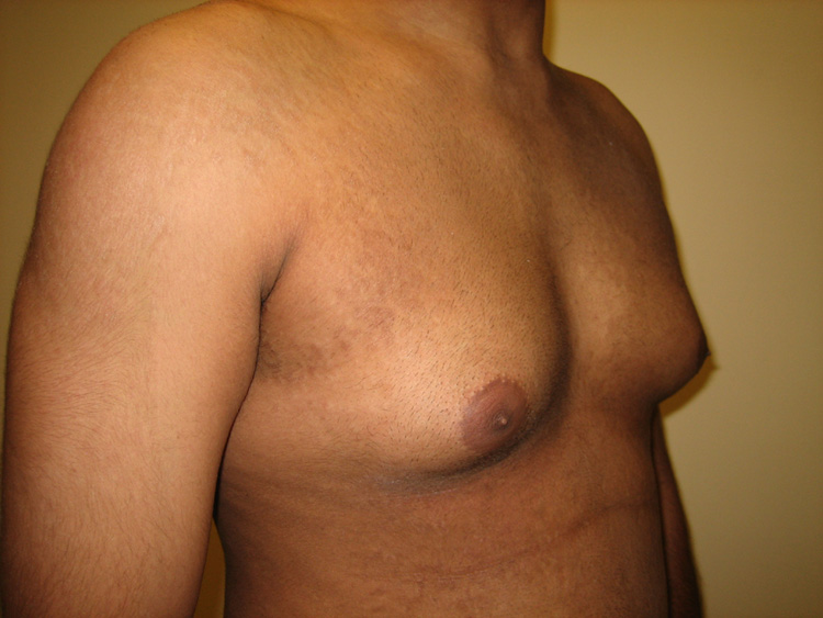 6c. Gyno Before