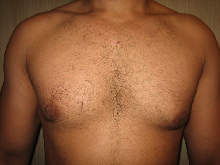 7a. Gyno Before