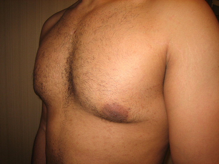 7c. Gyno Before