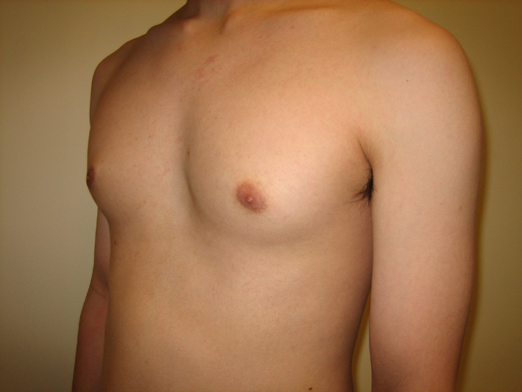 8c. Gyno Before