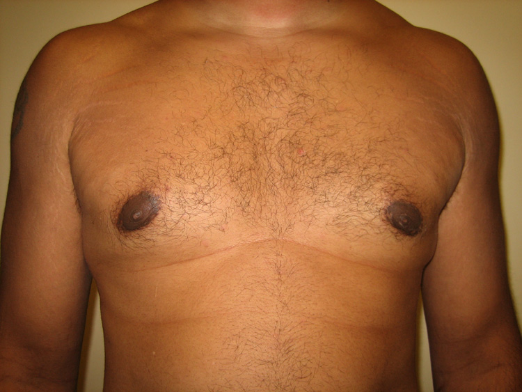 9a. Gynecomastia After