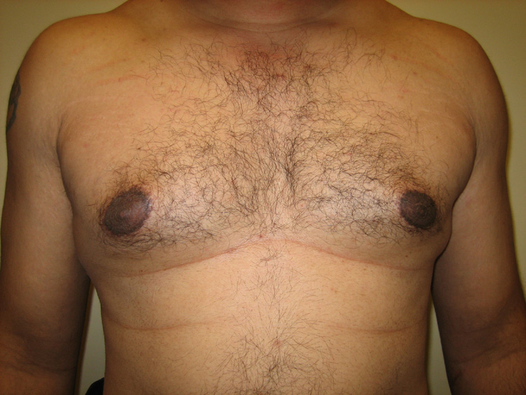 9a. Gynecomastia Before