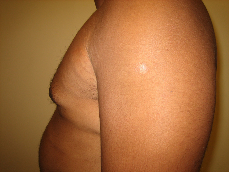 9b. Gynecomastia After