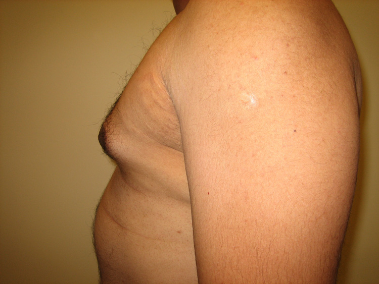 9b. Gynecomastia Before