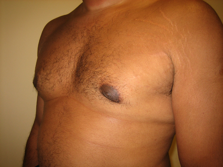 9c. Gynecomastia After