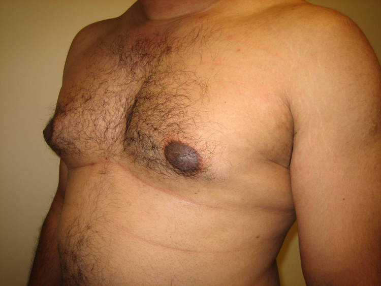 9c. Gynecomastia Before