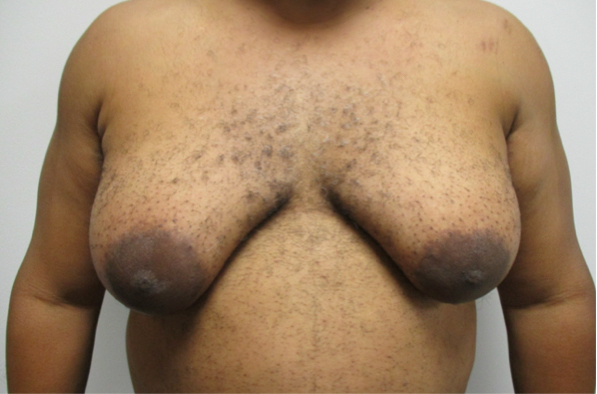 Gynecomastia Before Stage 4