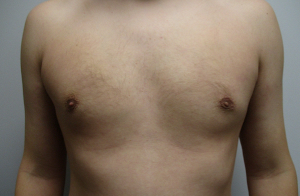 Gynecomastia Stage 3 After