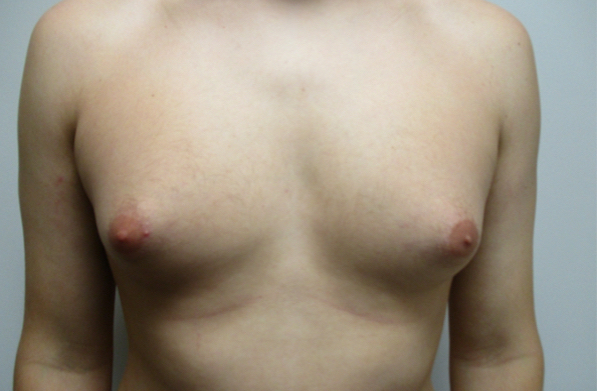 Gynecomastia Stage 3 Before