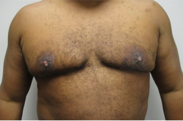 Gynecomastia Stage 4 After