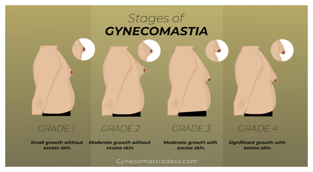 Gynecomastia Stages